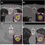 Congratulations to Hossein Naseri and co-authors for their publication in JMIR AI entitled “A scalable radiomics- and NLP- based machine learning pipeline to distinguish between painful and painless thoracic spinal bone metastases- Algorithm Development and Validation”