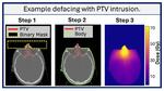 Congratulations to Kayla O'Sullivan-Steben and co-authors for their publication in Medical Physics entitled “Development of a defacing algorithm to protect the privacy of head and neck cancer patients in publicly-accessible radiotherapy datasets”